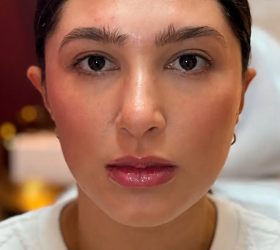 Rostro después del rejuvenecimiento facial